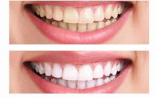 Candidates for Dental Cleaning and get paid $200