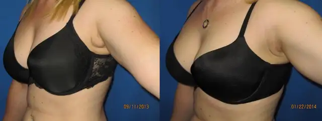 Side boob (axillary breast tissue) Removal