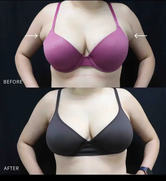 Side boob (axillary breast tissue) Removal - Photo 3