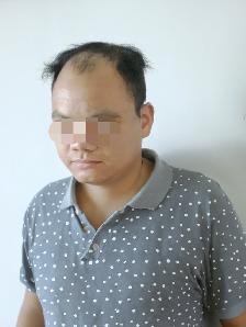 (HAIR LOSS)  Scalp Micropigmentation, FREE assessment - Photo 2