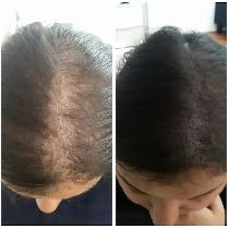 (HAIR LOSS)  Scalp Micropigmentation, FREE assessment - Photo 3