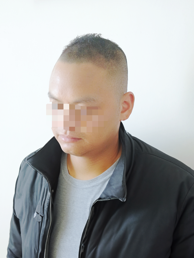 (HAIR LOSS)  Scalp Micropigmentation, FREE assessment