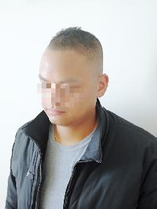 (HAIR LOSS)  Scalp Micropigmentation, FREE assessment