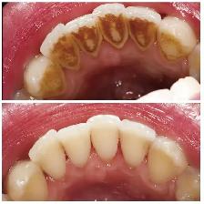 FREE DENTAL CLEANING