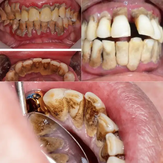 FREE DEEP DENTAL CLEANING – HIGH NEED CLIENTS ONLY WITH $200 REW - Photo 2