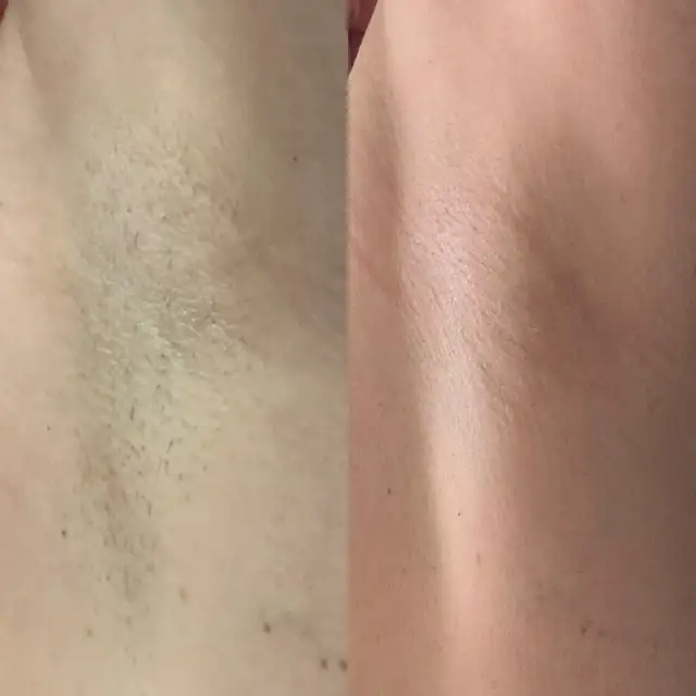 Laser Tattoo Removal   IPL   Cryo 6 – Full Clinic Equipment - Photo 6