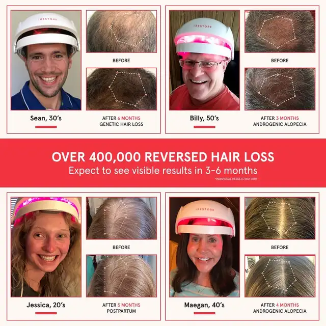 iRestore Essential - Laser Red Light Therapy for Hair Growth - Photo 2