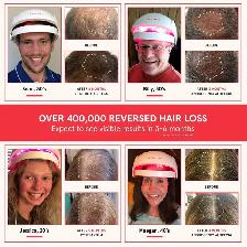 iRestore Essential - Laser Red Light Therapy for Hair Growth - Photo 2