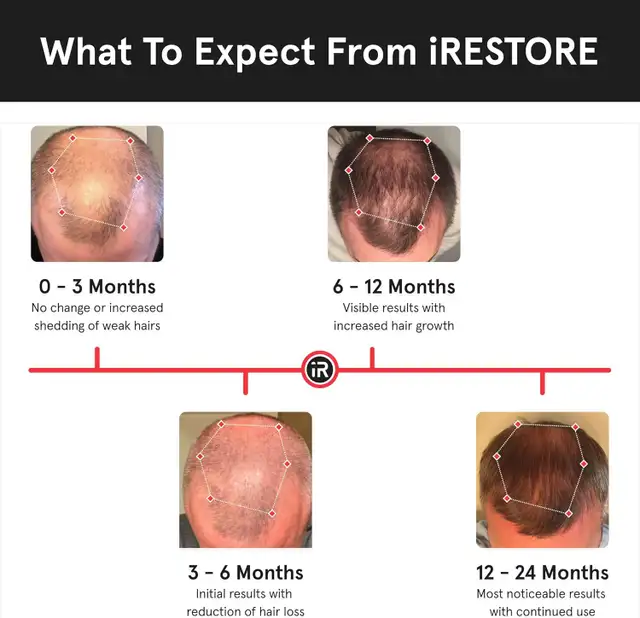 iRestore Essential - Laser Red Light Therapy for Hair Growth - Photo 4