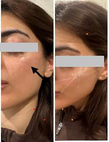 cheeks filler