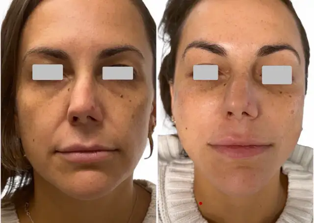 GLP1 facial