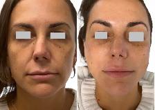 GLP1 facial
