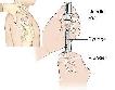 WOUNDCARE, IV, PHLEBOTOMYEKG IM INJECTION - CERTIFICATE PROGRAMS - Photo 3