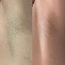 Laser Tattoo Removal | Hair Removal Bundle for Sale - Photo 4