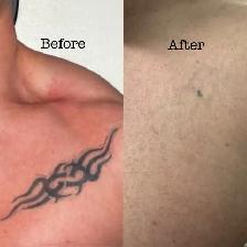 Laser Tattoo Removal | Hair Removal Bundle for Sale - Photo 5