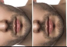 Chin / Jawline Filler