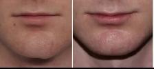 Chin / Jawline Filler - Photo 2