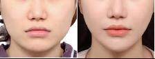 Chin / Jawline Filler - Photo 3