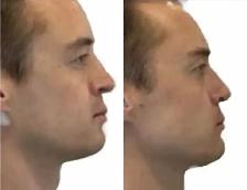 Chin / Jawline Filler - Photo 4