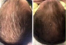 Hair Fall Treatment - Photo 3