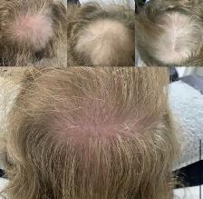 Hair Fall Treatment - Photo 4