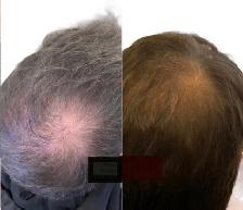 Stem Cell Hair Loss Treatment