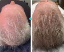 Stem Cell Hair Loss Treatment - Photo 4