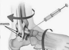 PRP Joint Injections - Photo 5