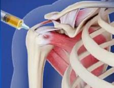 Regenerative Medicine / PRP Injection