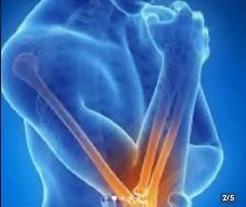 Regenerative Medicine / PRP Injection - Photo 4