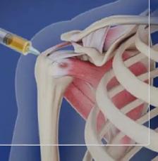 PRP injection / Sports Injury / Joint Injection - Photo 3