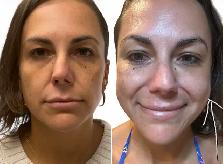 Liquid Face Lift