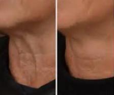 Liquid Face Lift - Photo 2