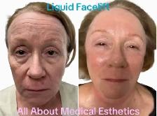Liquid Face Lift - Photo 4