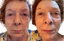 Liquid Face Lift - Photo 5