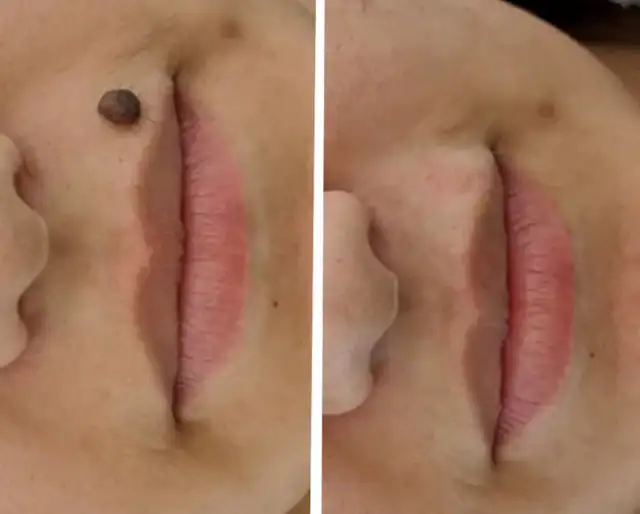 Mole Removal Skin Tag Removal
