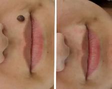 Mole Removal Skin Tag Removal