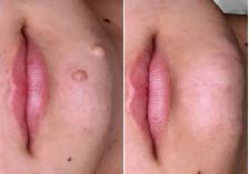 Mole Removal Skin Tag Removal - Photo 2