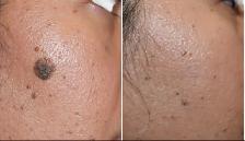 Mole Removal Skin Tag Removal - Photo 3