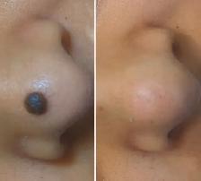Mole Removal Skin Tag Removal - Photo 4