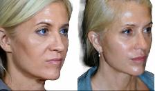 Face lift (non-surgical) - Photo 2