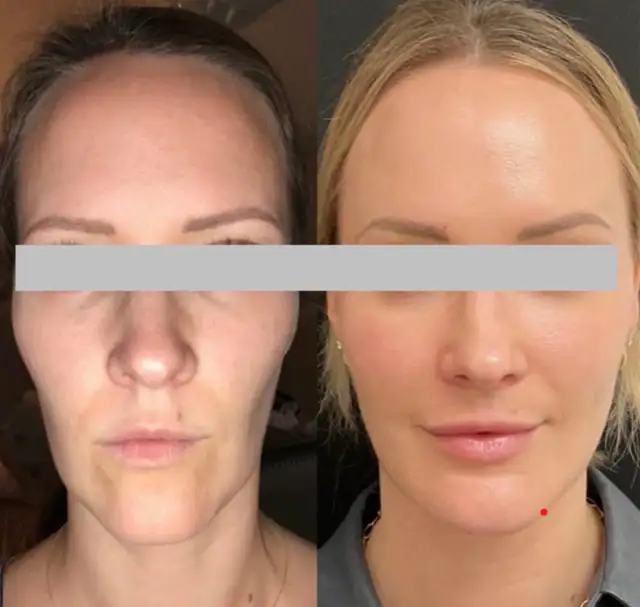 nonsurgical Facelift