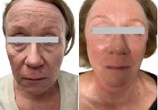 nonsurgical Facelift - Photo 2