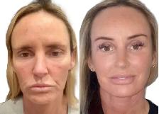 nonsurgical Facelift - Photo 3