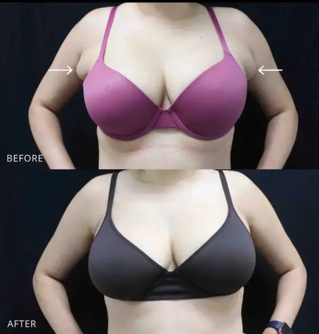 Permanent Fat dissolving