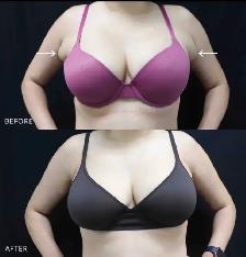 Permanent Fat dissolving