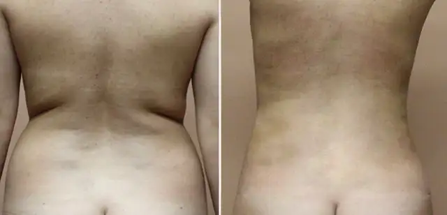 Permanent Fat Removal