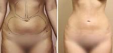 Permanent Fat Removal - Photo 3