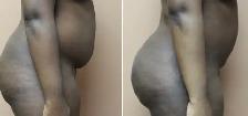 Permanent Fat Removal - Photo 6