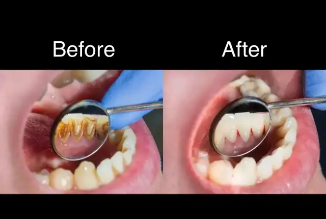 Free Dental Cleaning